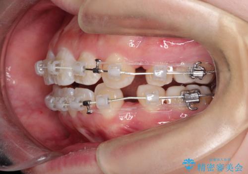 【審美ワイヤー】口ボコをなおしたいの治療中