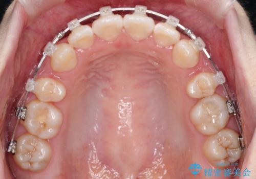 【審美ワイヤー】口ボコをなおしたいの治療中