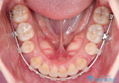 【審美ワイヤー】口ボコをなおしたいの治療中