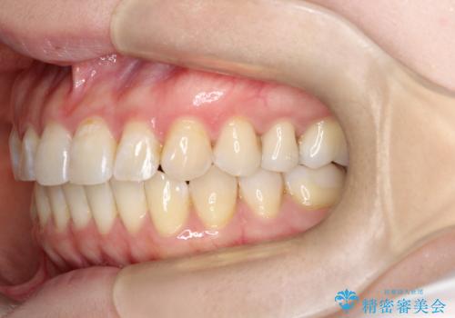 【インビザライン 】前歯の凸凹をなおしたいの治療後
