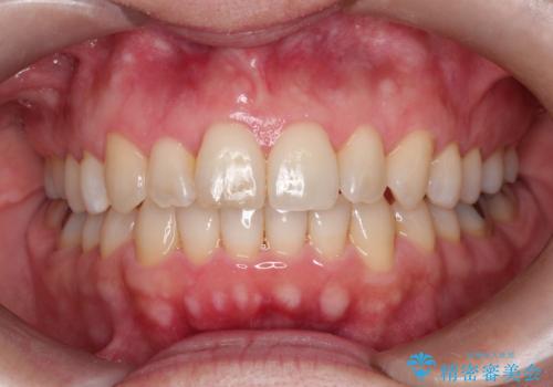 【インビザライン 】前歯のガタガタを治したいの治療後