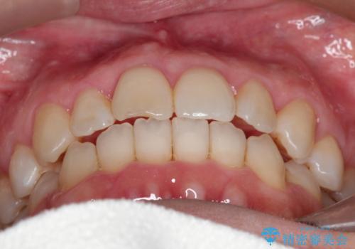 【インビザライン 】前歯のガタガタを治したいの治療後