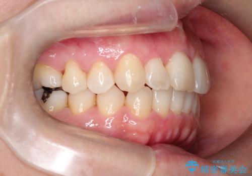 【インビザライン 】前歯のガタガタを治したいの治療後