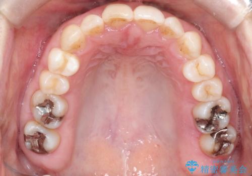 【インビザライン 】前歯のガタガタを治したいの治療後