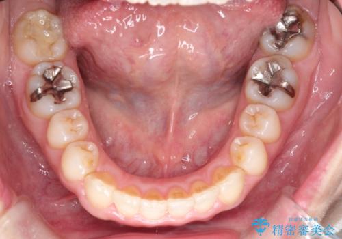 【インビザライン 】前歯のガタガタを治したいの治療後