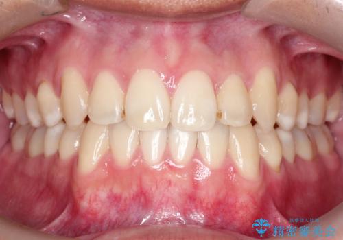 【MSE+インビザライン】前歯のガタガタの症例 治療後