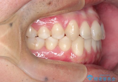 【MSE+インビザライン】前歯のガタガタの治療後