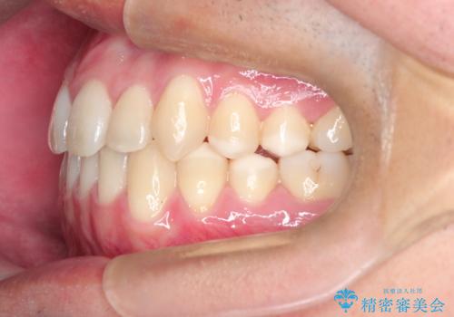 【MSE+インビザライン】前歯のガタガタの治療後
