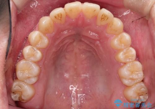 【MSE+インビザライン】前歯のガタガタの治療後