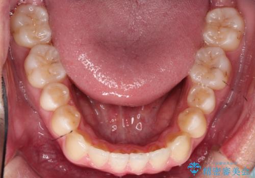 【MSE+インビザライン】前歯のガタガタの治療後