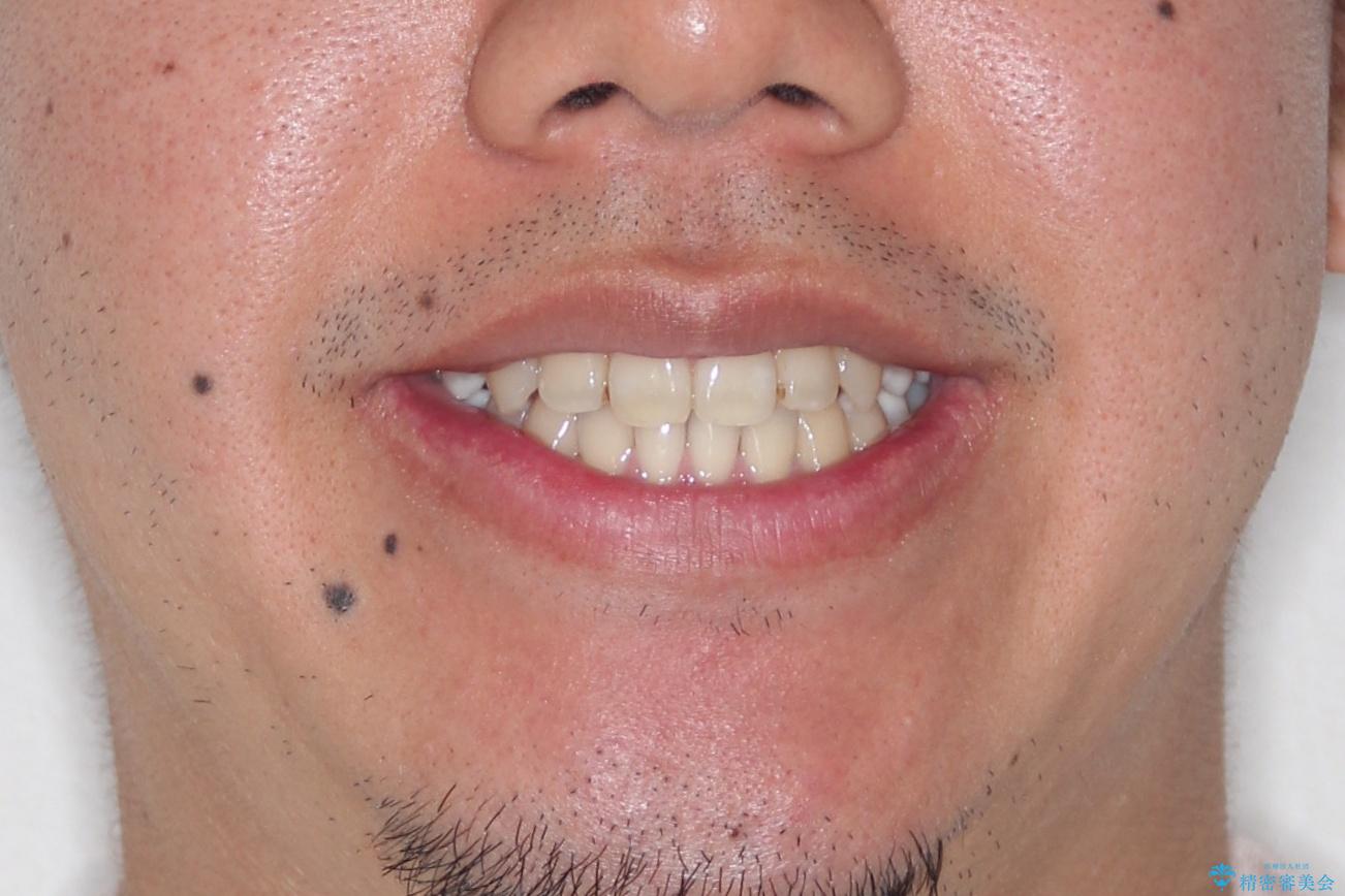【MSE+インビザライン】前歯のガタガタの治療後（顔貌）