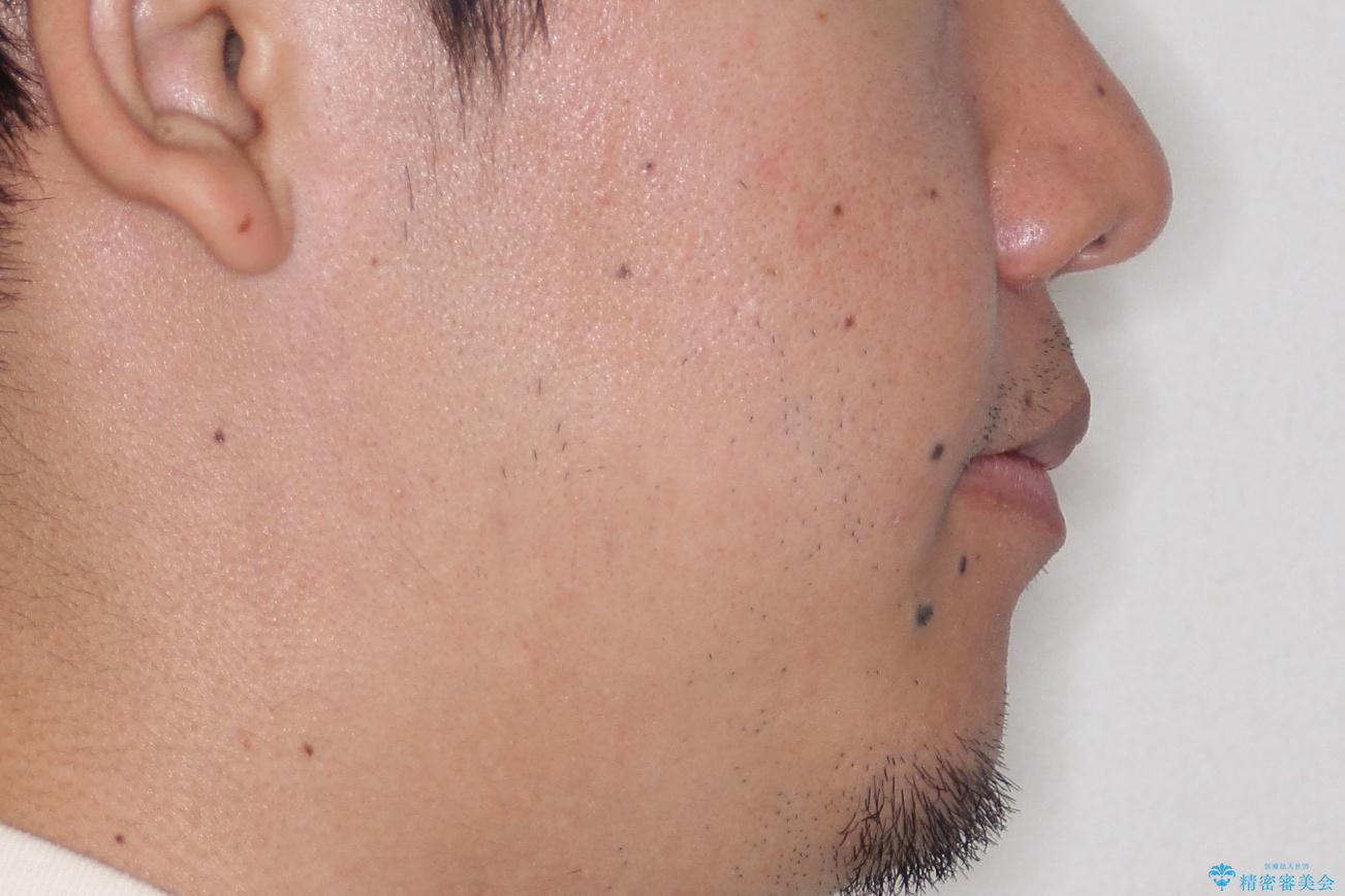 【MSE+インビザライン】前歯のガタガタの治療後(顔貌)