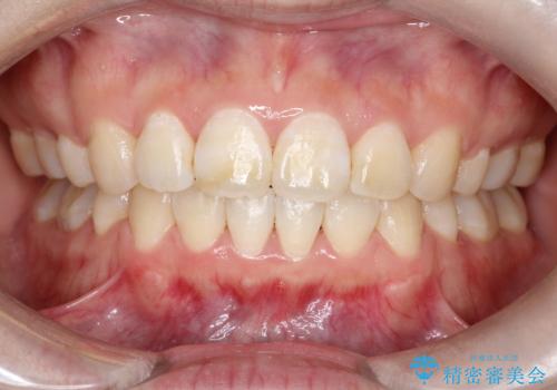 【審美ワイヤー】口ボコをなおしたいの治療後
