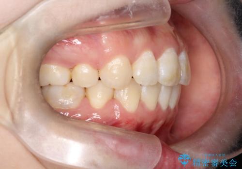 【審美ワイヤー】口ボコをなおしたいの治療後