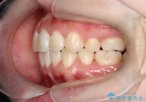 【審美ワイヤー】口ボコをなおしたいの治療後