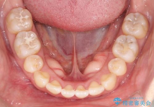 【審美ワイヤー】口ボコをなおしたいの治療後