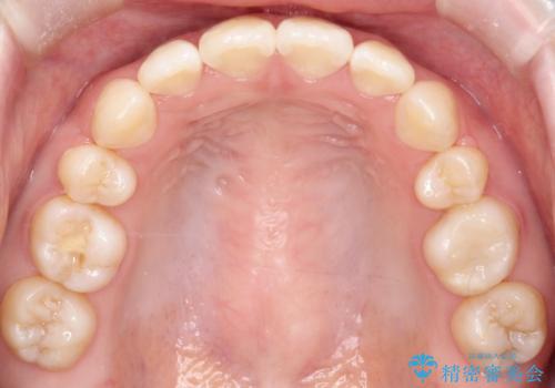 【審美ワイヤー】口ボコをなおしたいの治療後