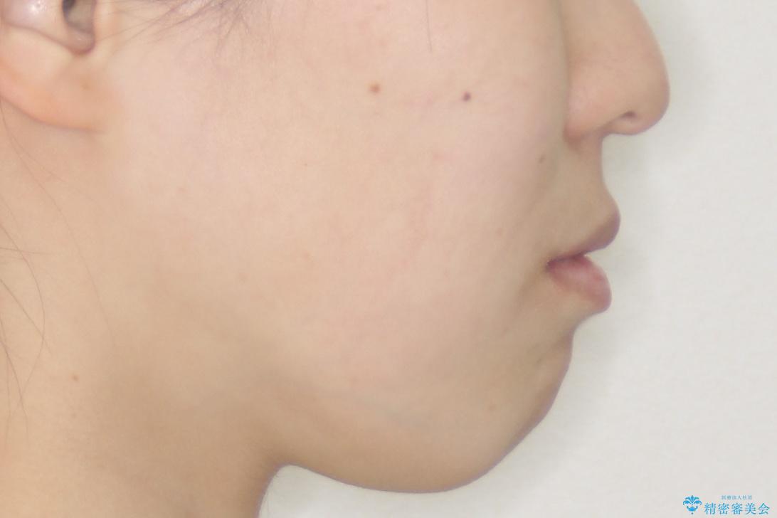 【審美ワイヤー】口ボコをなおしたいの治療後(顔貌)