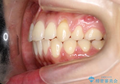 【審美ワイヤー】短期間で矯正完了の治療後
