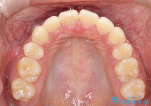 【審美ワイヤー】短期間で矯正完了の治療後
