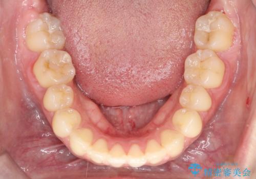 【審美ワイヤー】短期間で矯正完了の治療後