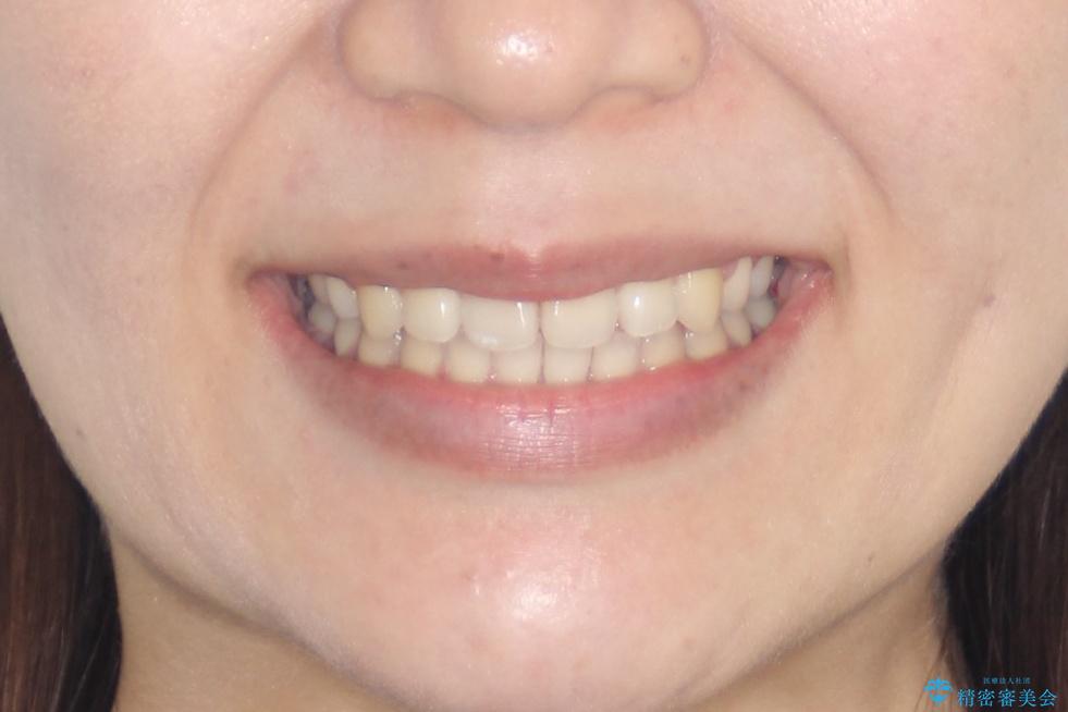 【審美ワイヤー】短期間で矯正完了の治療後(顔貌)