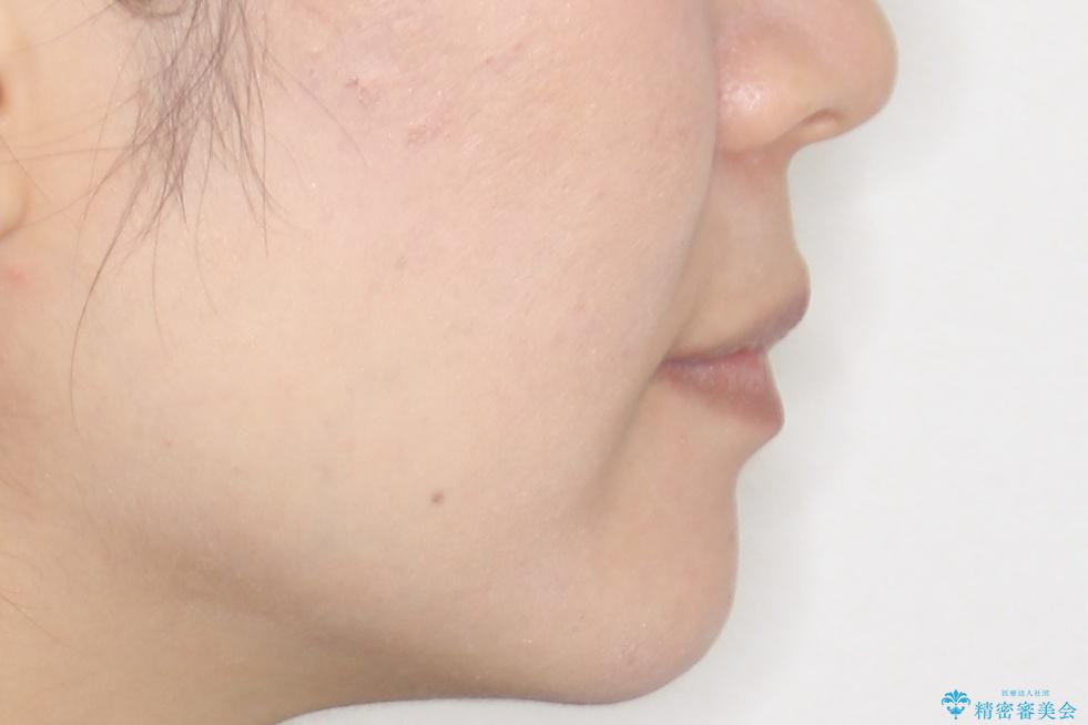 【審美ワイヤー】短期間で矯正完了の治療後(顔貌)