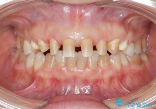 劣化してきた前歯ラミネートをジルコニアクラウンへの治療中