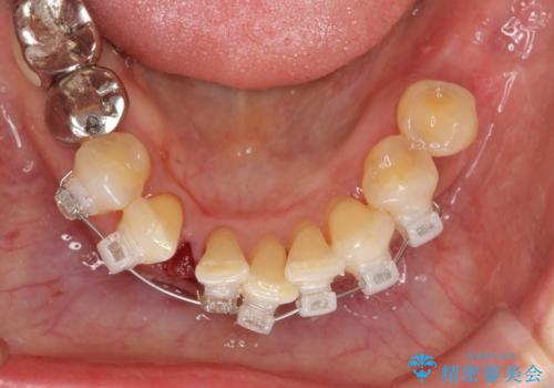 前歯のすれ違いによる歯周病を矯正治療で改善の治療中