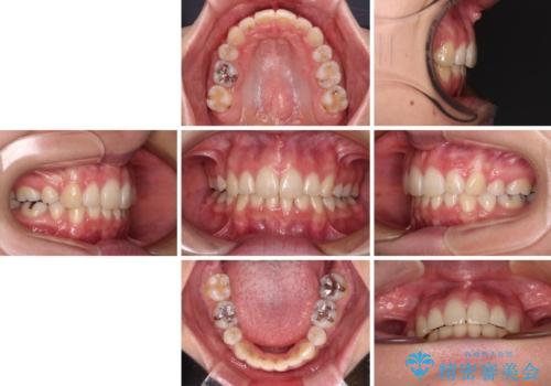 デコボコで飛び出した前歯 ワイヤー装置による抜歯矯正の治療後