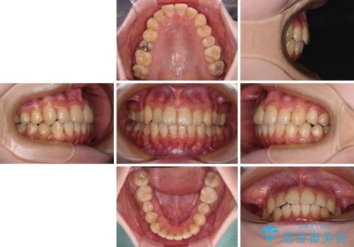 デコボコ歯列をきれいに インビザラインによる矯正治療の治療後