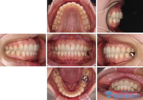 出産をしながら歯列を整える インビザラインによる矯正治療の治療後