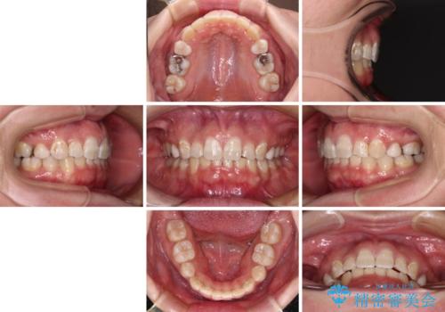 著しい八重歯を短期間で改善 ワイヤー装置による抜歯矯正の治療後