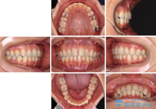 前歯の叢生をいつの間にか改善 インビザラインによる矯正治療の治療後