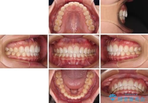 【モニター】前歯のすきっ歯をインビザラインで改善の治療後