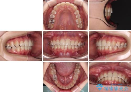 楽してクロスバイトを治したい ワイヤー装置による矯正治療の治療後