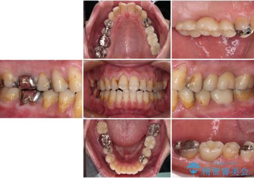 欠損と痛み 奥歯のむし歯治療の治療後