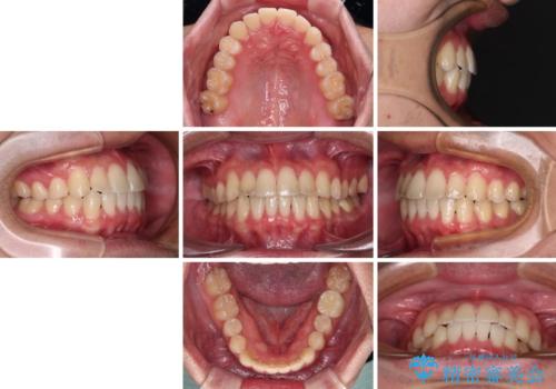 【モニター】前歯のクロスバイトと隙間を改善　インビザラインによる矯正治療の治療後