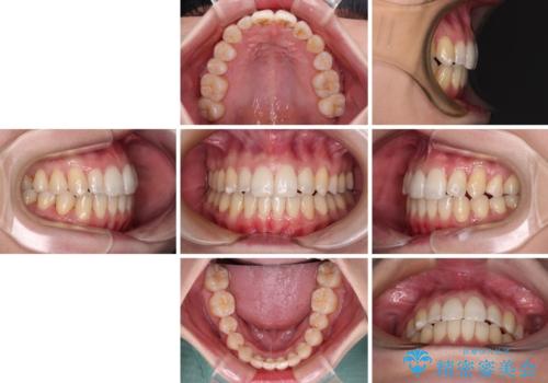 補助装置を併用したインビザラインでの八重歯の抜歯矯正の治療後