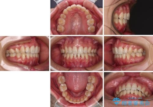 Eラインを改善したい ハーフリンガルによる抜歯矯正の治療後