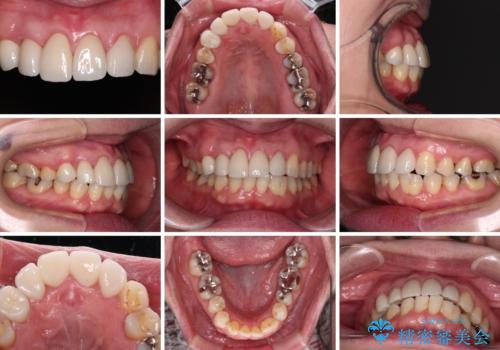 八重歯と形の悪い前歯　矯正治療とセラミック治療の治療後