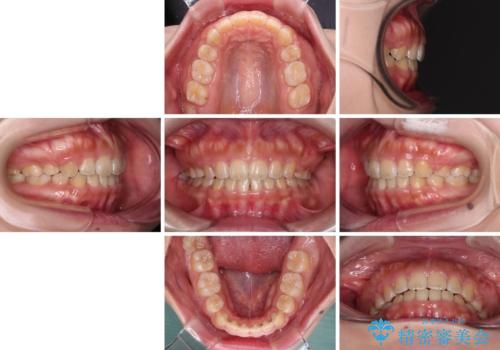 口元を引っ込めたい 目立たないワイヤー装置での抜歯矯正の治療後