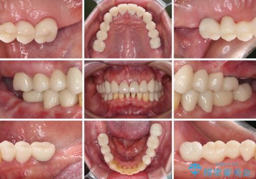 銀歯や入れ歯で汚い歯をきれいにしたい 総合歯科治療の治療後