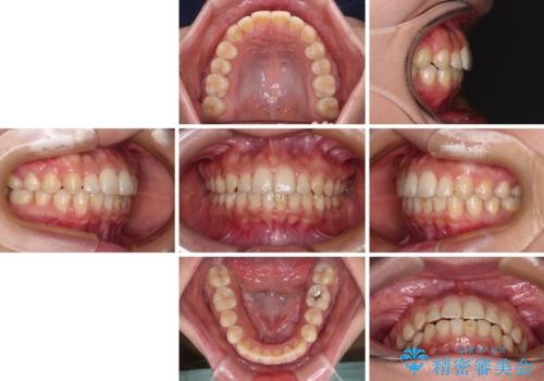 前歯のクロスバイト 目立たないワイヤー装置で速やかに矯正治療の治療後