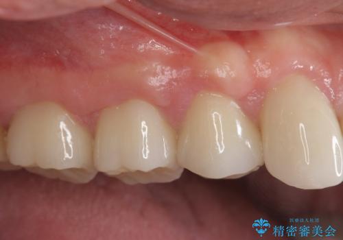 歯周外科で達成する安定したクラウン周囲の歯肉環境