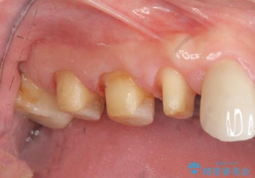 歯周外科で達成する安定したクラウン周囲の歯肉環境の治療中