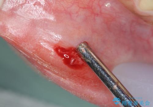 唇がたびたび腫れる 粘液嚢胞の摘出の治療中