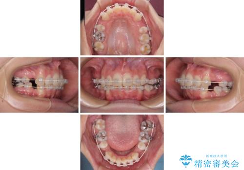 デコボコで飛び出した前歯 ワイヤー装置による抜歯矯正の治療中