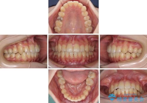 デコボコ歯列をきれいに インビザラインによる矯正治療の治療中