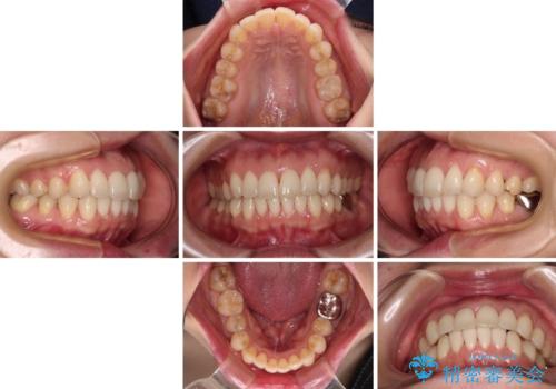 出産をしながら歯列を整える インビザラインによる矯正治療の治療中